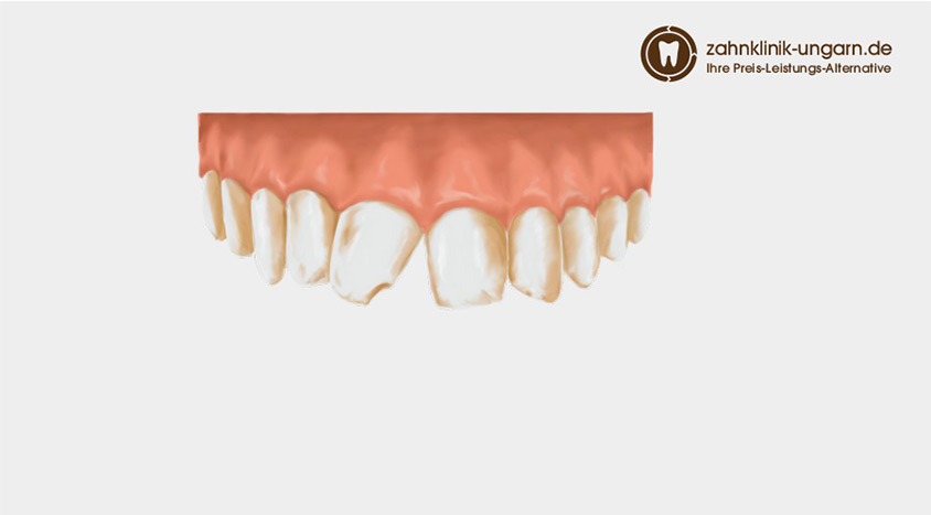 krumme Zähne vor Veneers-Behandlung